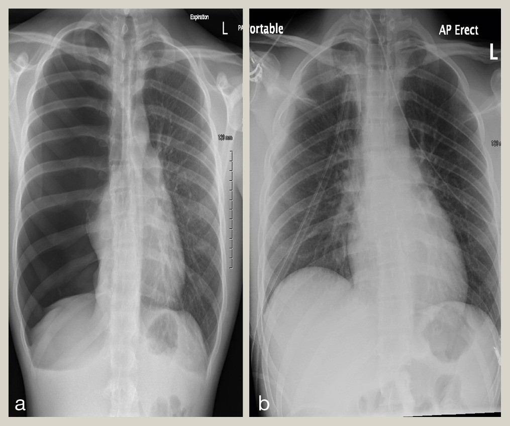 X-thorax pneumothorax